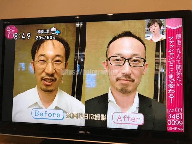 【嘘やん】NHKあさイチがハゲ特集！信じてたことが違うの！？
